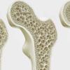 Osteoporosis Risk in India: Study Finds 50.3% of Men Have Osteopenia