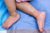 Hand, foot and mouth disease cases reported in Delhi NCR; know early symptoms, causes, preventive measures