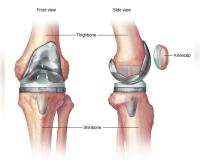 India needs more skilled surgeons for revision knee, hip replacement surgeries, say experts