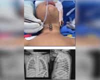 AIIMS doctors remove 2-inch-long metal spring from 14-month-old's food pipe