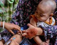 Resurgent Measles Crisis: Bangladesh Launches Emergency Vaccination Campaign Amid Rising Child Mortality