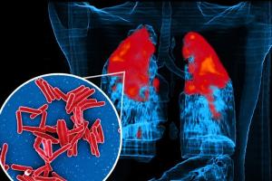 IIT Bombay study shows how TB bacteria shield themselves from antibiotics, stay alive longer