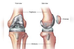 India needs more skilled surgeons for revision knee, hip replacement surgeries, say experts