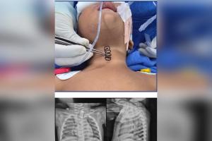 AIIMS doctors remove 2-inch-long metal spring from 14-month-old's food pipe