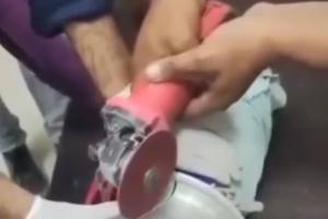 Surgical Precision Saves Toddler After Freak Accident with Kitchen Utensil