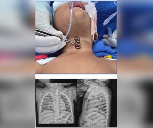 AIIMS doctors remove 2-inch-long metal spring from 14-month-old's food pipe